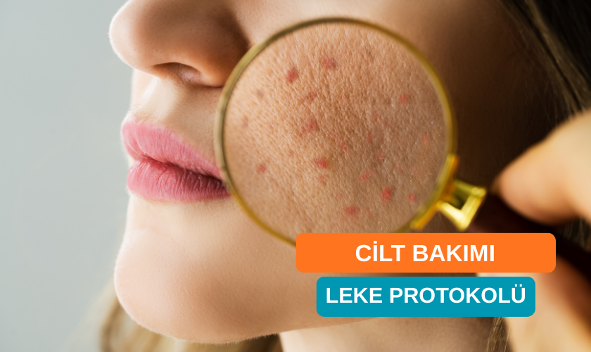 Profesyonel Leke Protokolü ile Leke Tedavisi